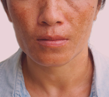 Melasma
