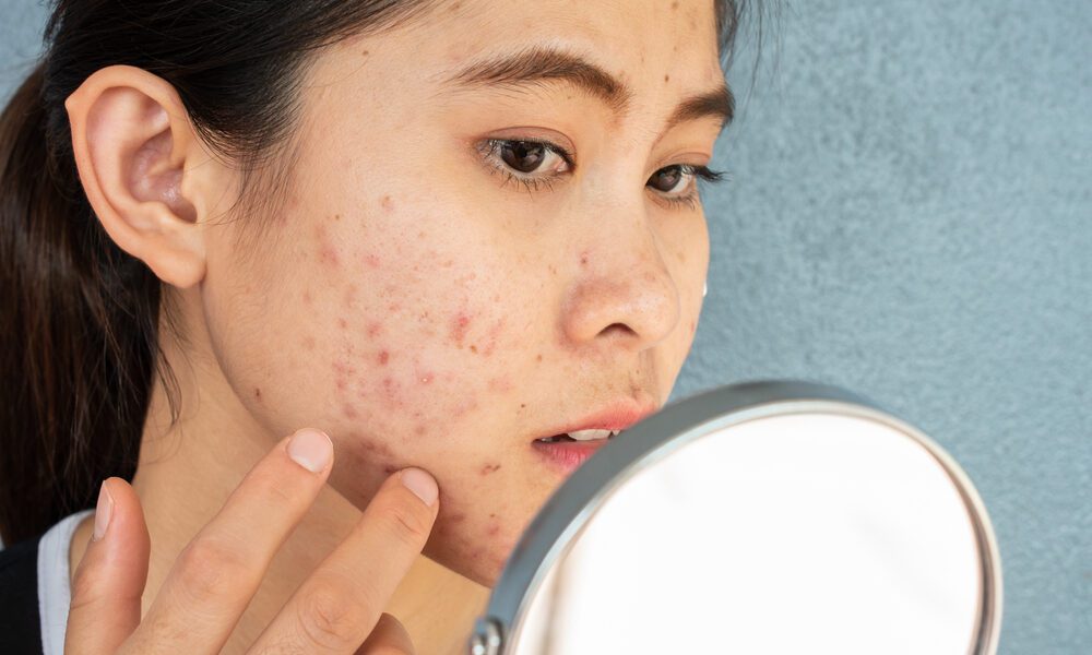 Mulher com traços orientais segura o espelho e observa rosto com acne