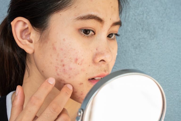 Mulher com traços orientais segura o espelho e observa rosto com acne