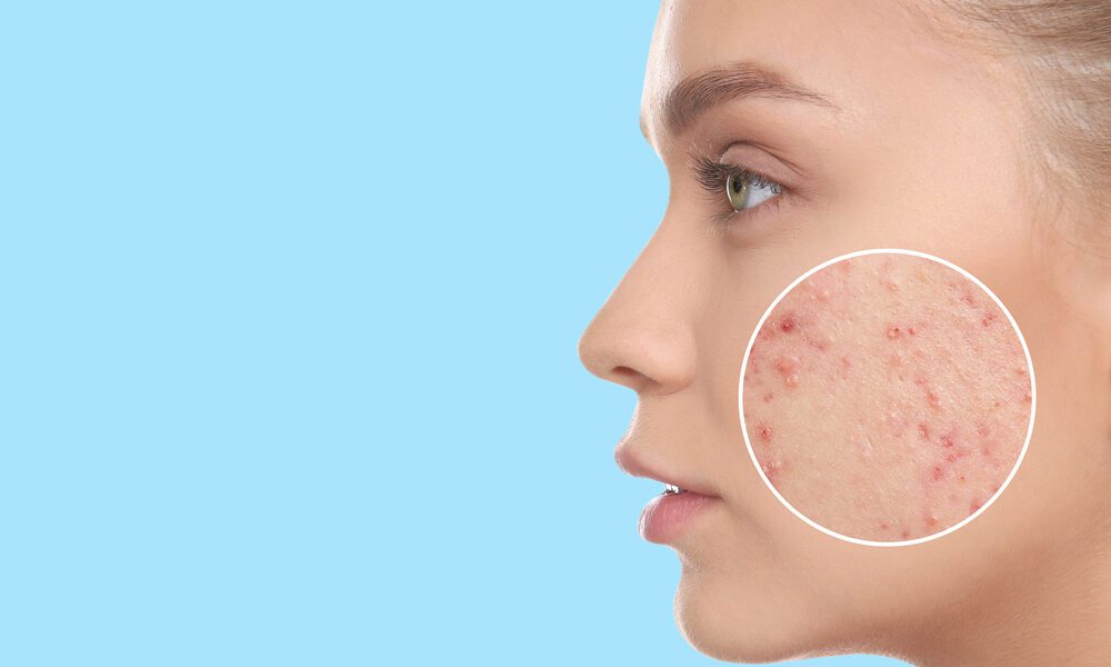 Pele de mulher ampliada para que os poros sejam visíveis