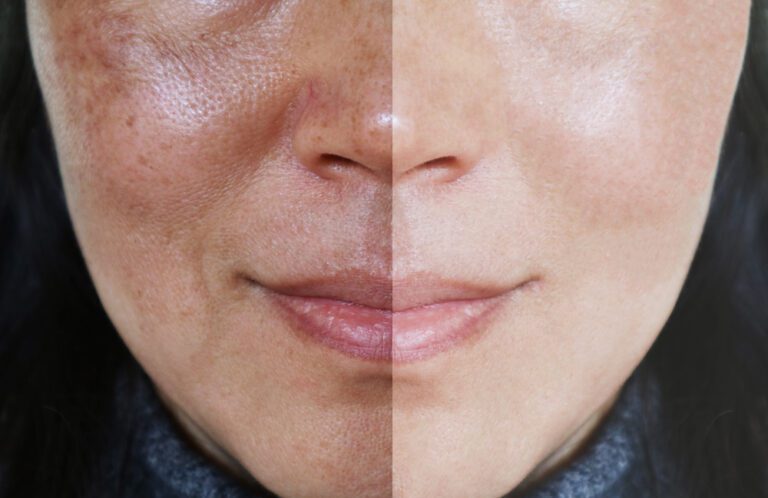 Antes e depois do tratamento do melasma