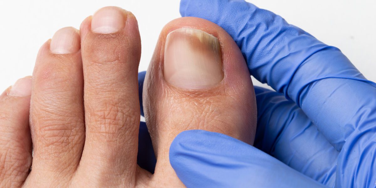 Pé com micose de unha no dedão