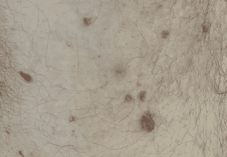 Pele de paciente com Acrocórdon