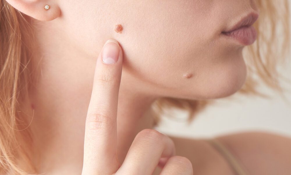 Mulher apontando para verruga no rosto