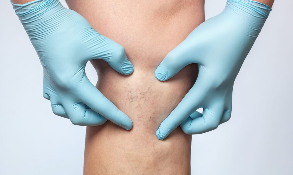 Duas mãos pressionando perna com vasinhos