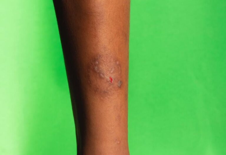 Pele do braço machucada e com infecção