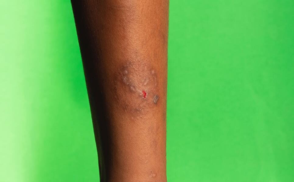 Pele do braço machucada e com infecção