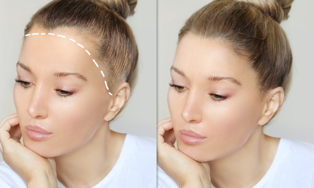 Comparação lateral de uma mulher com alopecia fibrosante frontal