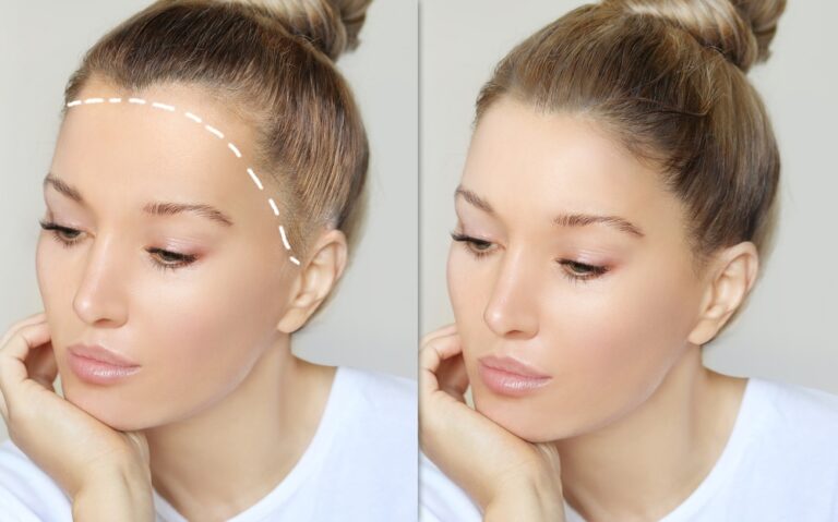 Comparação lateral de uma mulher com alopecia fibrosante frontal