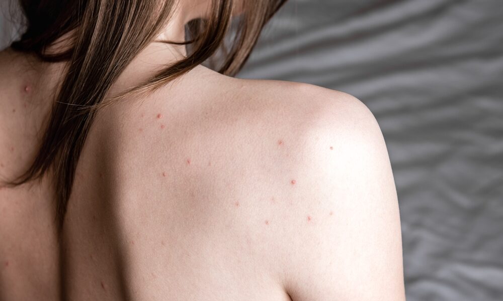 Mulher com pintas nas costas e cabelo castanho