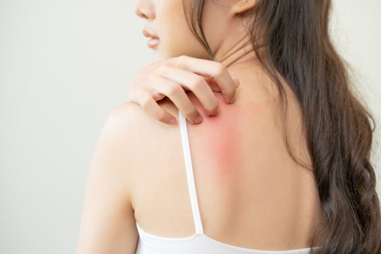 Imagem ilustrativa de mulher com pele vermelha nas costas e coçando a dermatite atópica